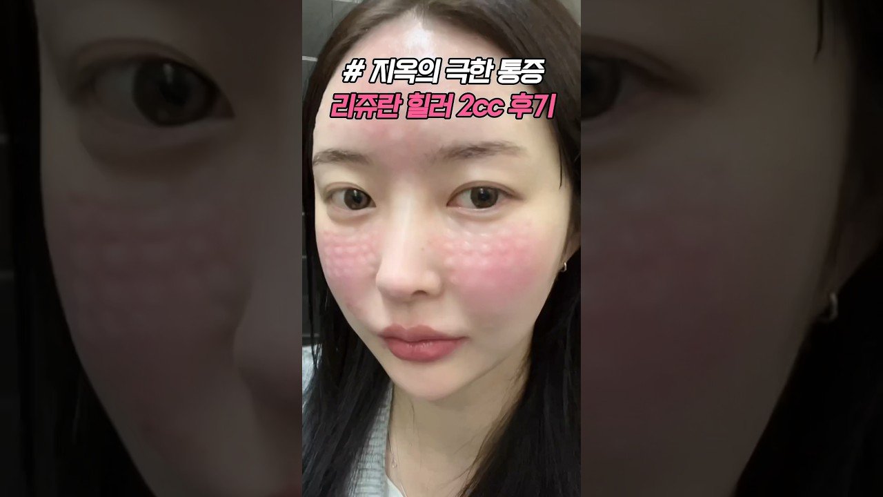 리쥬란힐러 2일간의 피부 변화 리뷰