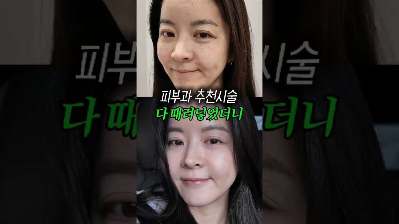 20년 만에 피부과 내돈내산 리얼 후기 리뷰